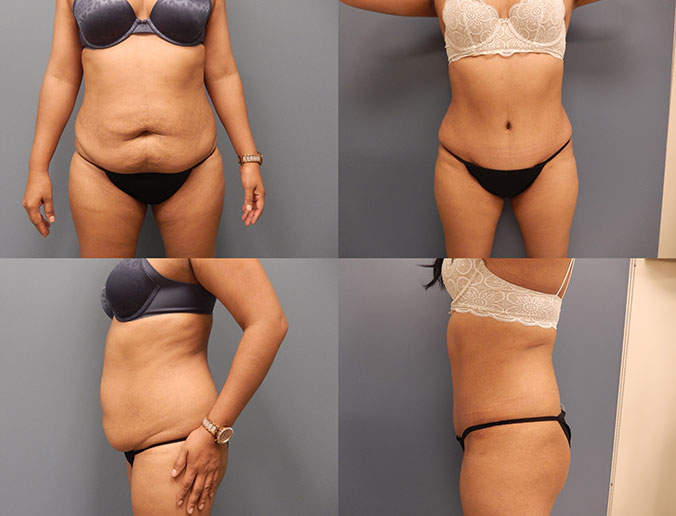 Tummy Tuck Raleigh Patient 113