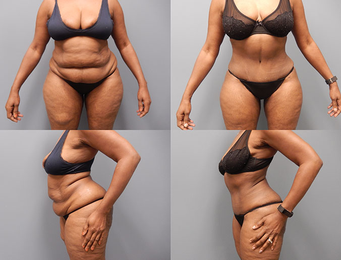 Tummy Tuck Raleigh Patient 116