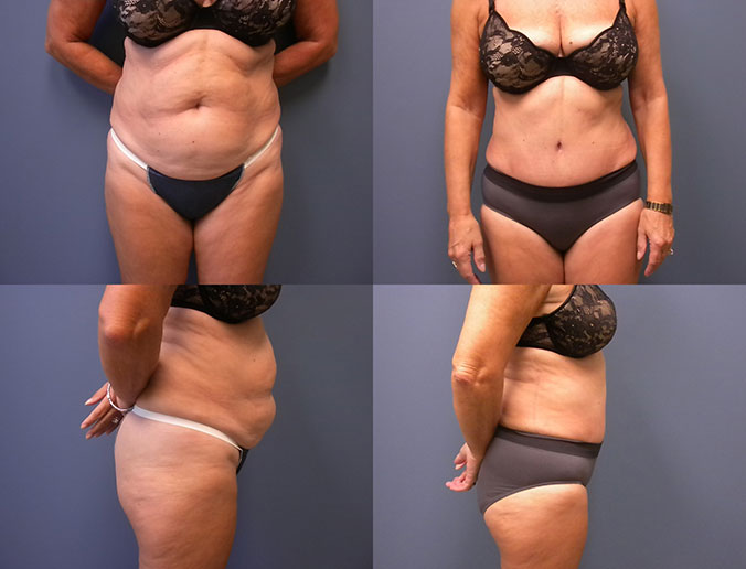 Tummy Tuck Raleigh Patient 12 2