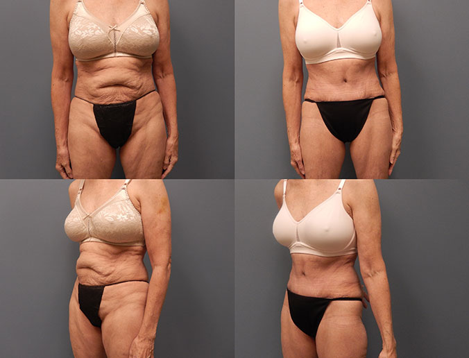 Tummy Tuck Raleigh Patient 123