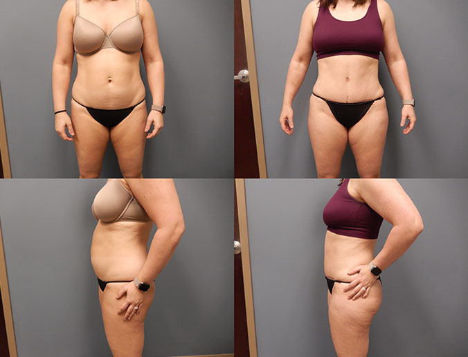 Tummy Tuck Raleigh Patient 127