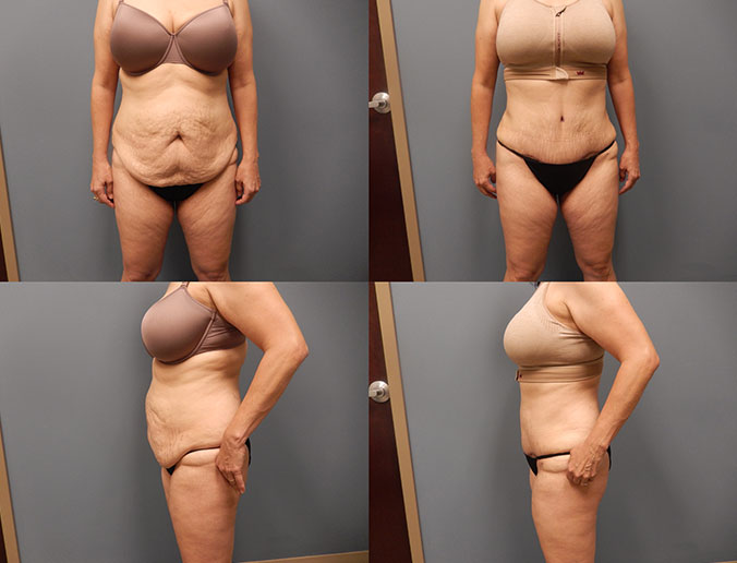 Tummy Tuck Raleigh Patient 128
