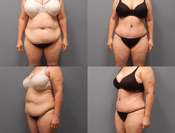 Tummy Tuck Raleigh Patient 140