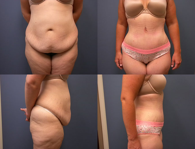 Tummy Tuck Raleigh Patient 27