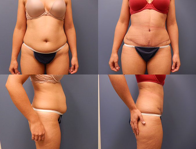 Tummy Tuck Raleigh Patient 73
