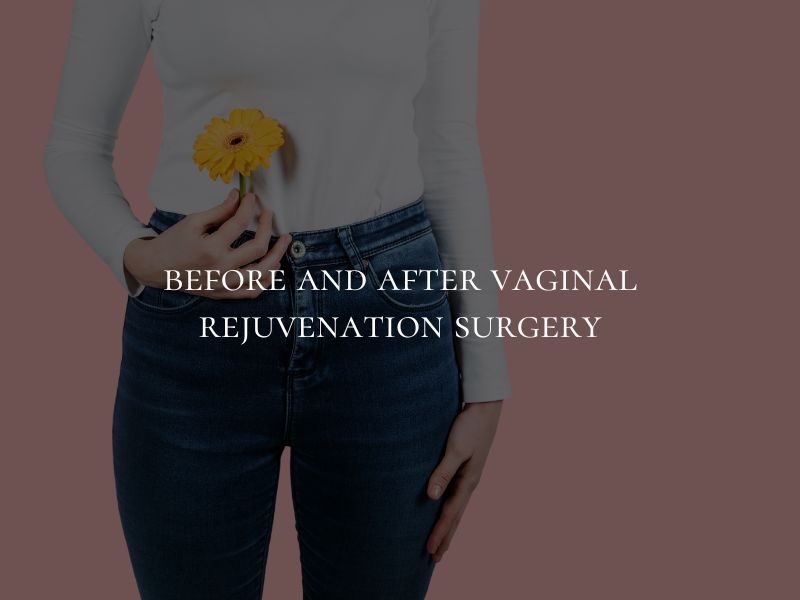 before and after vaginal rejuvenation surgery