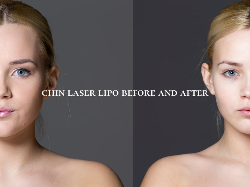 chin laser lipo before and after