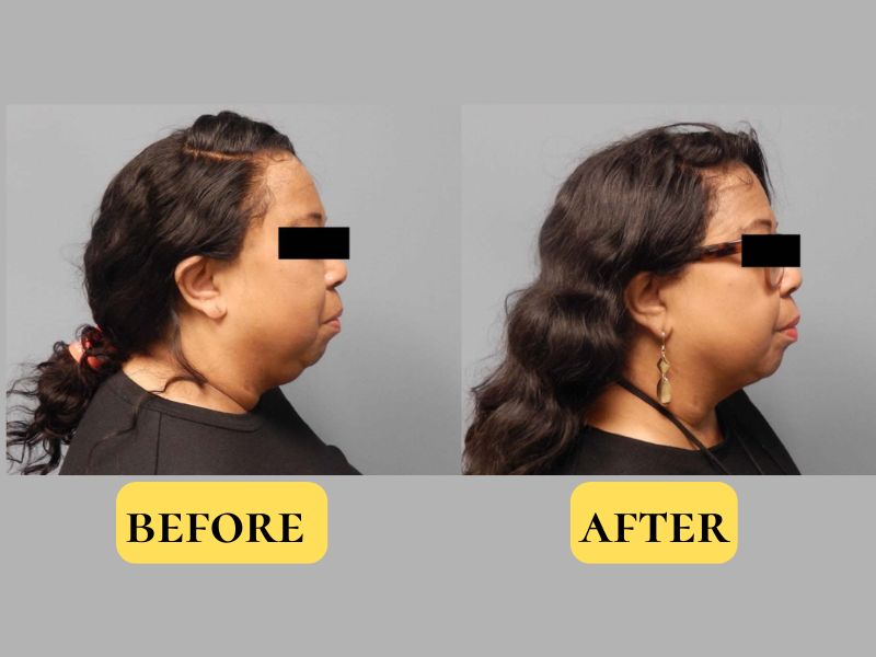 double chin lipo before and after