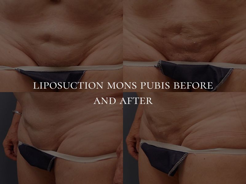 liposuction mons pubis before and after