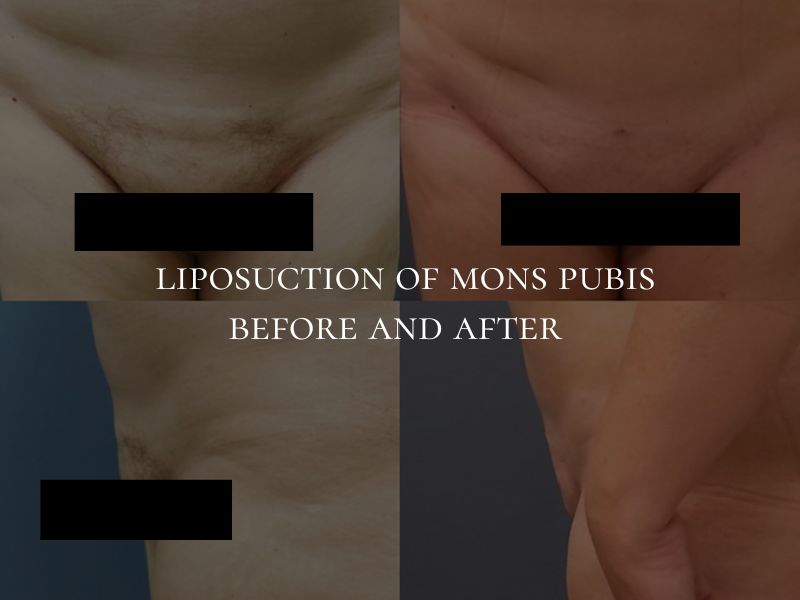 liposuction of mons pubis before and after