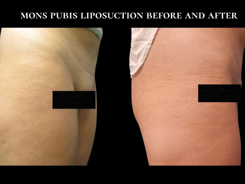 mons pubis liposuction before and after