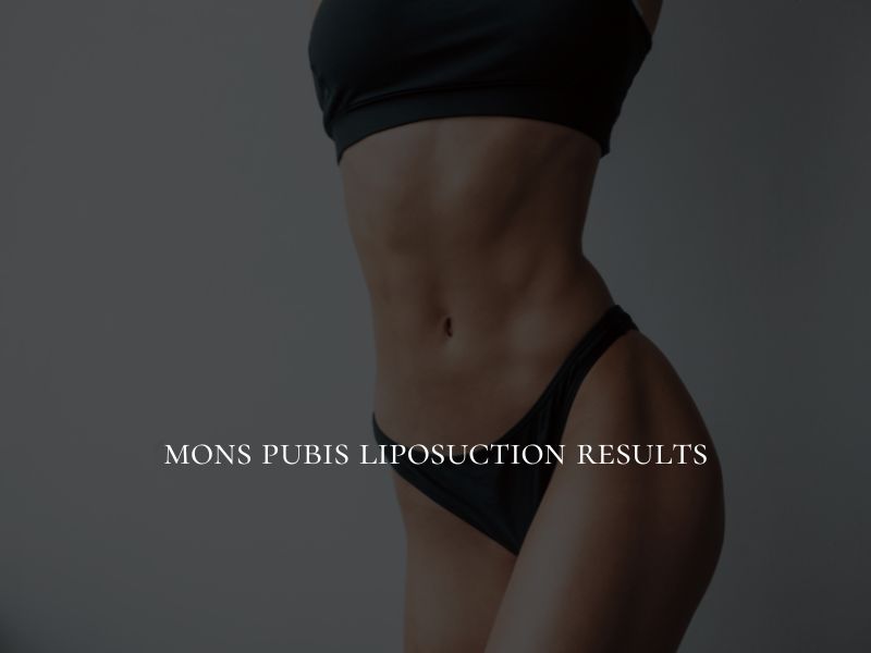 mons pubis liposuction results