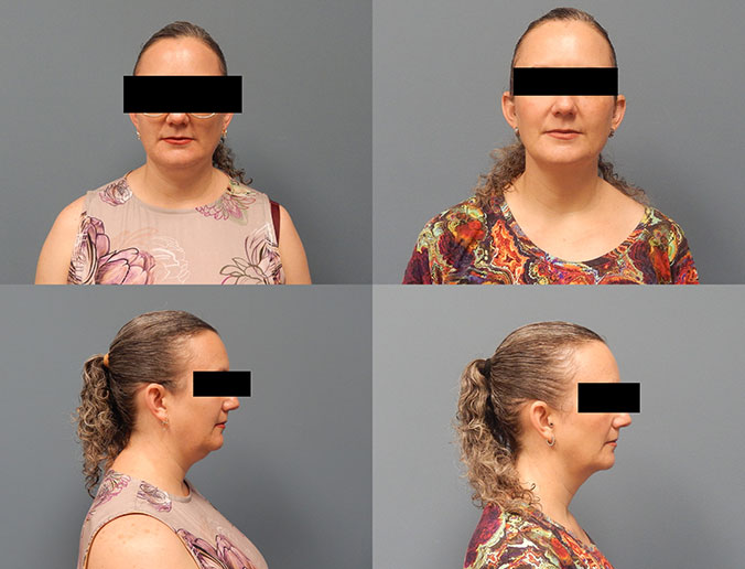 submental lipo before and after
